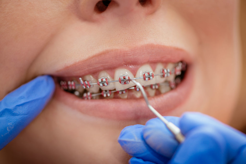 Traitement orthodontique avec un orthodontite dans notre cabinet à Lausanne.